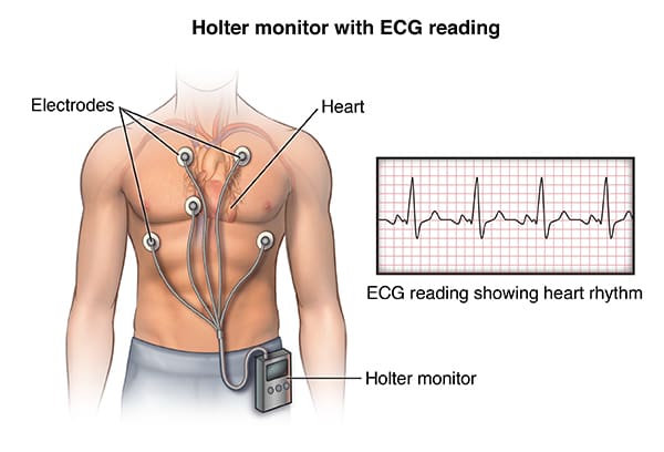 Holter Monitoring with ECG Reading infographic.