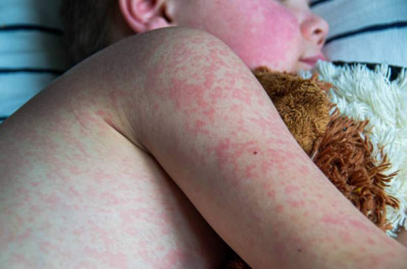 Child holding teddy bear with rubella rash appearing on child's skin