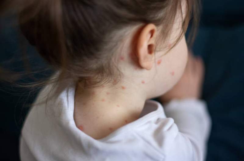 Young child with measles marks appearing on face and neck