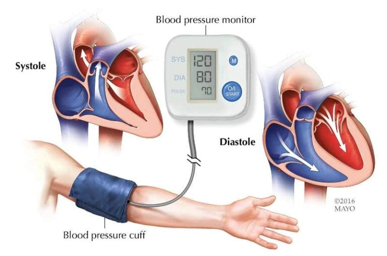 24 Hour Blood Pressure Monitoring Brisbane | Book Now - NSMC