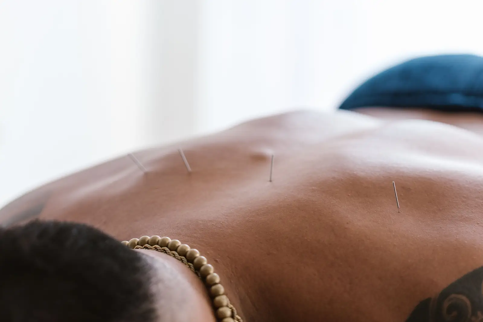 Dry Needling Brisbane North