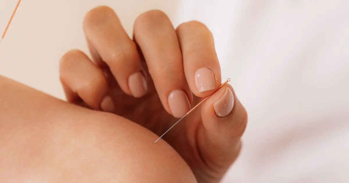 Dry Needling Therapy Narangba